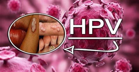 hpv 痣|HPV: o que é, sintomas, tratamentos e doenças provocadas pelo。